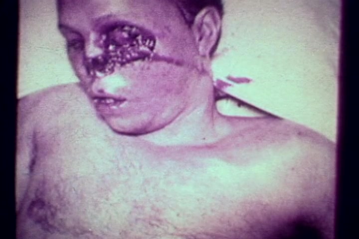 The still from 'Drug Abuse: Some Comments from the Morgue' depicts a deceased male individual lying on a surface. He shows severe facial trauma, particularly around one eye, with noticeable decay. The image presents a stark and graphic illustration of the impacts of drug abuse, highlighting the grim realities associated with substance-related mortality. The overall tone is unsettling and serves as a cautionary reminder against drug use.
