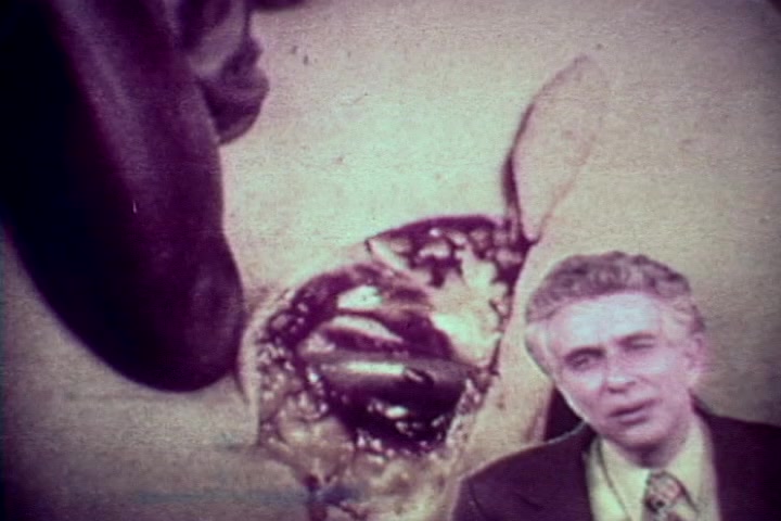 The still from 'Drug Abuse: Some comments from the morgue' features a close-up of a grim and graphic scene, likely depicting the aftermath of drug use. In the foreground, Tillman Hahn from the Medical Examiner's office speaks directly to the camera, providing commentary on the serious consequences of drug abuse. The overlaid imagery suggests the stark realities of drug-related fatalities, aiming to shock viewers and convey the dangers of substance misuse. The overall tone is somber and cautionary, characteristic of anti-drug messaging from the 1970s.
